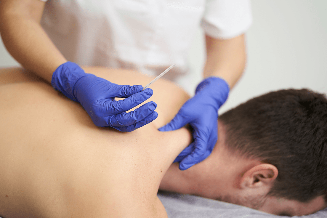 Kuru İğneleme (Dry Needling)